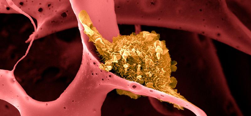 Forradalmi rákgyógyszer mutatott 100%-os hatékonyságot klinikai vizsgálatokban