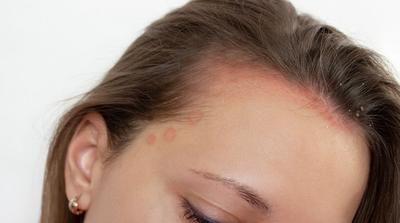 Az atópiás dermatitisz korai felismerése: miért olyan fontos?