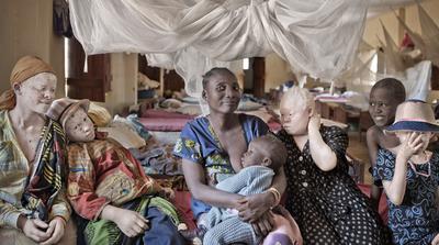 Albínó emberek élete a tét Tanzániában: rettegés és üldöztetés