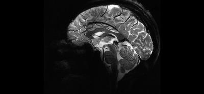 A világ legerősebb MRI-gépe forradalmasíthatja az agykutatást